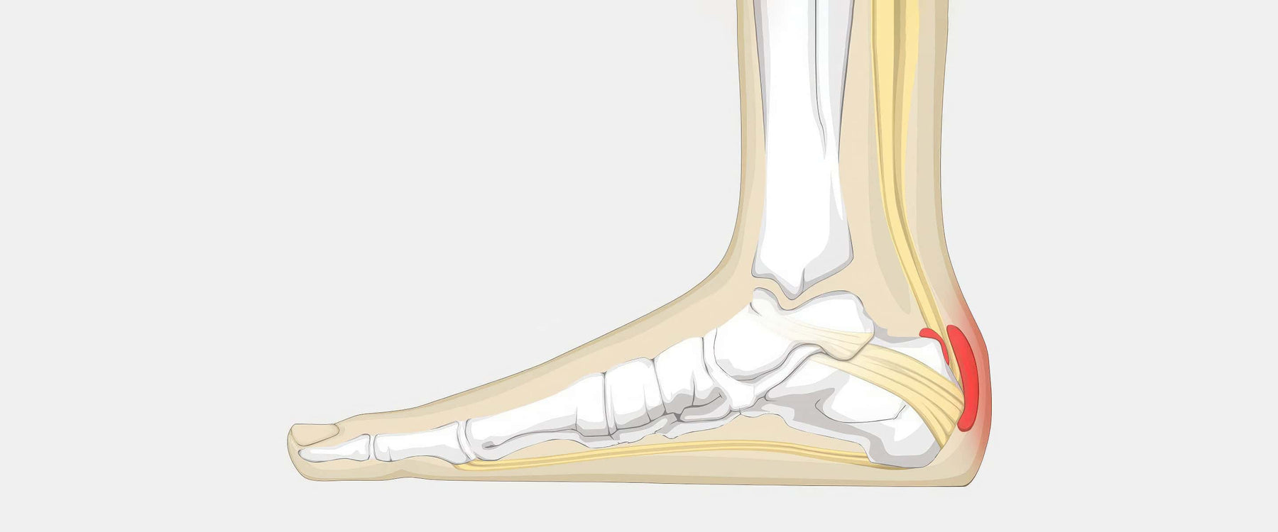 Achilles Bursitis Illustration