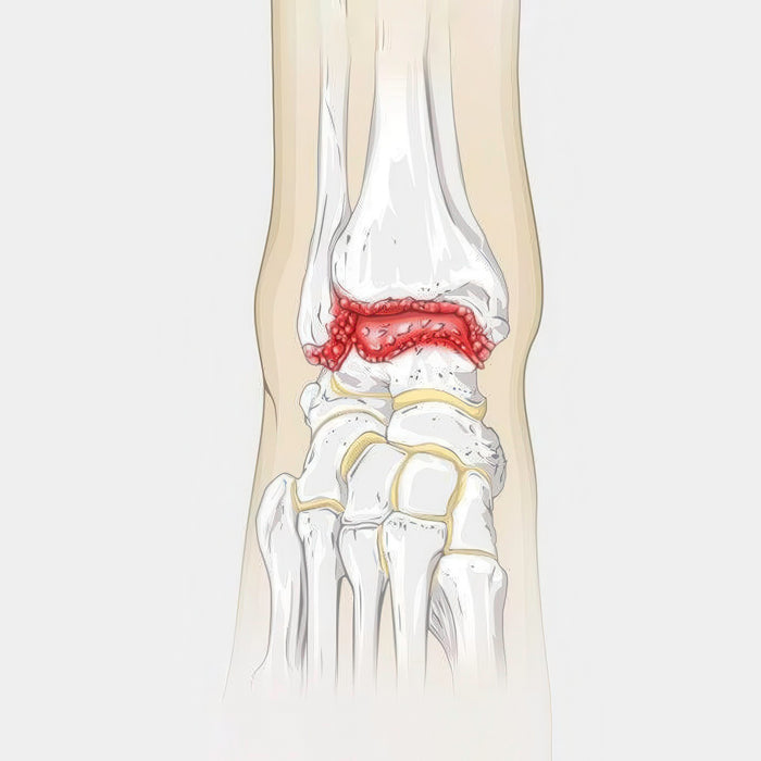 Ankle Arthritis Illustration