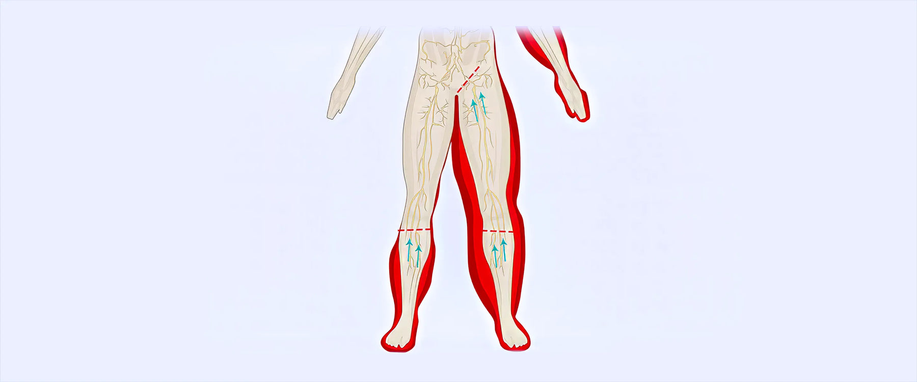 Lymphedema Diagram