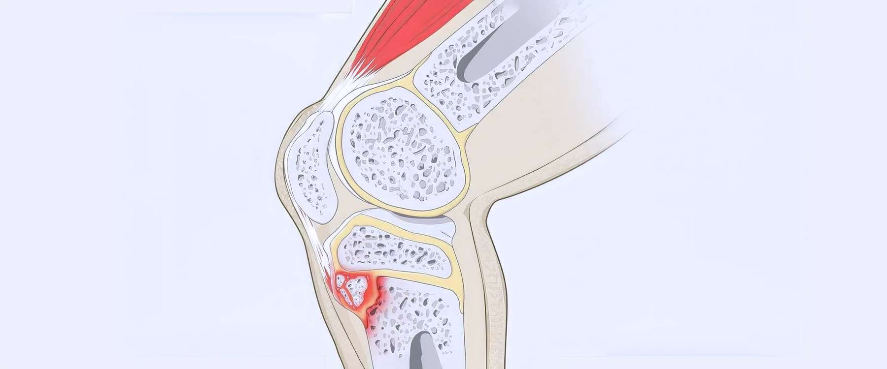 Osgood schlatter disease illustration