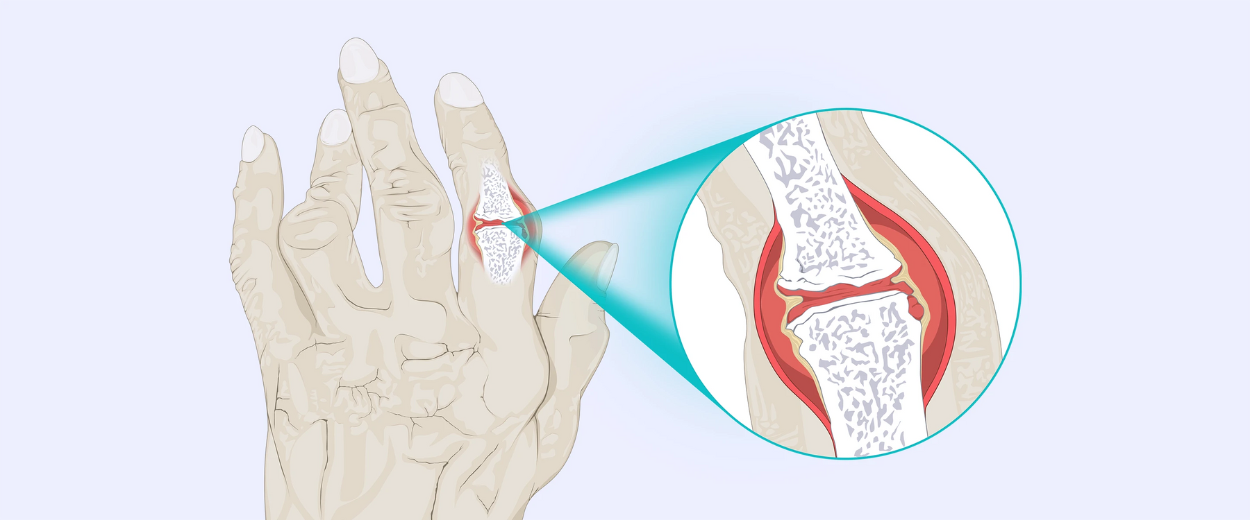 Rheumatoid Arthritis Illustration